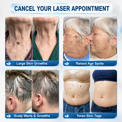 30𝐇𝐈𝐒𝐊𝐈𝐍®👩‍⚕️ 𝟕-𝐃𝒂𝘆 𝐒𝗸𝐢𝐧 𝐓𝒂𝗴 & 𝐒𝐩𝙤𝐭 𝐄𝐫𝒂𝐬𝙚𝐫 Painless & Scar-Free Advanced Imperfection Removal Rollerball Pen（副本）