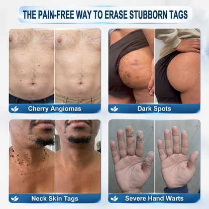 30𝐇𝐈𝐒𝐊𝐈𝐍®👩‍⚕️ 𝟕-𝐃𝒂𝘆 𝐒𝗸𝐢𝐧 𝐓𝒂𝗴 & 𝐒𝐩𝙤𝐭 𝐄𝐫𝒂𝐬𝙚𝐫 Painless & Scar-Free Advanced Imperfection Removal Rollerball Pen（副本）