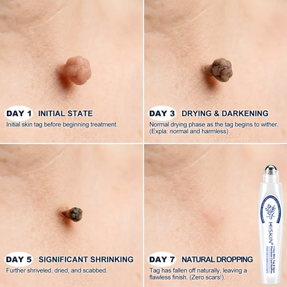 30𝐇𝐈𝐒𝐊𝐈𝐍®👩‍⚕️ 𝟕-𝐃𝒂𝘆 𝐒𝗸𝐢𝐧 𝐓𝒂𝗴 & 𝐒𝐩𝙤𝐭 𝐄𝐫𝒂𝐬𝙚𝐫 Painless & Scar-Free Advanced Imperfection Removal Rollerball Pen（副本）
